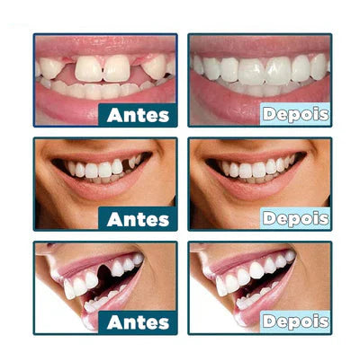 Facetas Dentárias Naturais Removíveis | SmileFix Pro